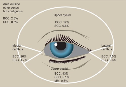 Figure 8 Location of eyelid malignancies: percentages for 174 tumors.