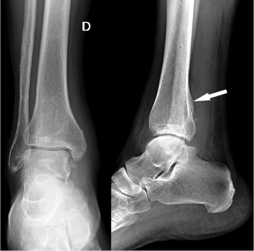 Figure 1. Posterior tibial bony callus (arrow) of the right ankle.