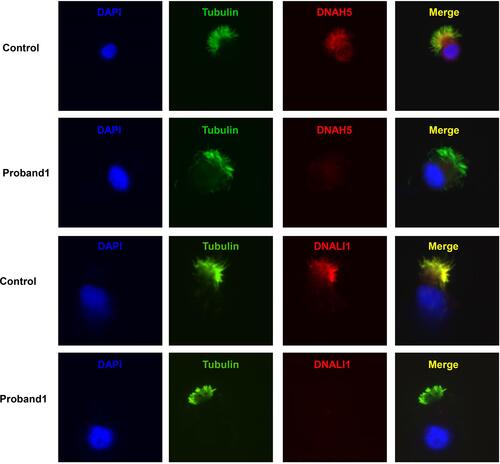 Figure 4 Immunofluorescence of nasal ciliated cells revealed the absence of DNAH5 and DNALI1 of proband 1. Anti-acetylated tubulin monoclonal antibody was used to mark the ciliary axoneme. DNAH5 was used to label the outer dynein arm (ODA), DNALI1 was used to label the inner dynein arm (IDA) and DAPI was used to label the nuclei.