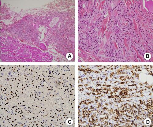 Figure 3 Histopathologic examination of left orbital biopsy specimen (case 1). (A) Section of biopsy specimen showing neoplastic cells (HPS stain, ×10). (B) Increased nuclear size with increased nuclear/cytoplasmic ratio. Infiltration of normal muscle fibers and adipocytes by neoplastic cells (HPS stain, ×40). (C) Immunohistochemical staining of tumor cells, suggesting a metastatic breast adenocarcinoma (immunohistochemical staining positive for GATA3, ×200). (D) Immunohistochemical staining of tumor cells, suggesting a metastatic breast adenocarcinoma (immunohistochemical staining positive for E-cadherin, ×200).