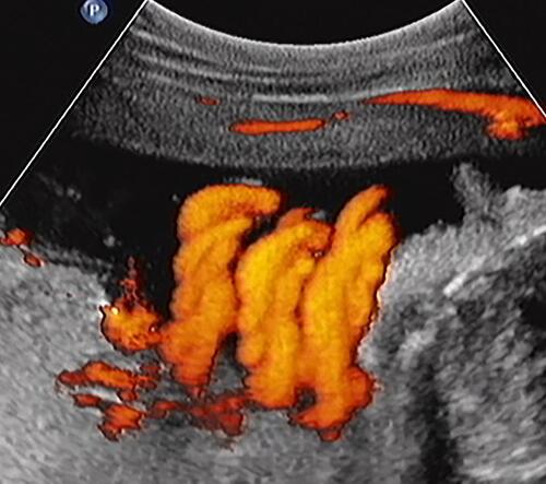Figure 4 Sagittal image of the fetal neck. Fetal cranium is to the right of the image. Power Doppler depicting a triple nuchal cord.