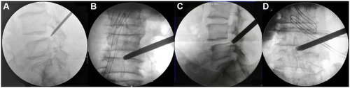 Figure 1 Fluoroscopic views before endoscopic manipulation. (A and B) The drill was inserted to resect the LF and the ventral osteophytes on the SAP. (C and D) The working cannula was placed.