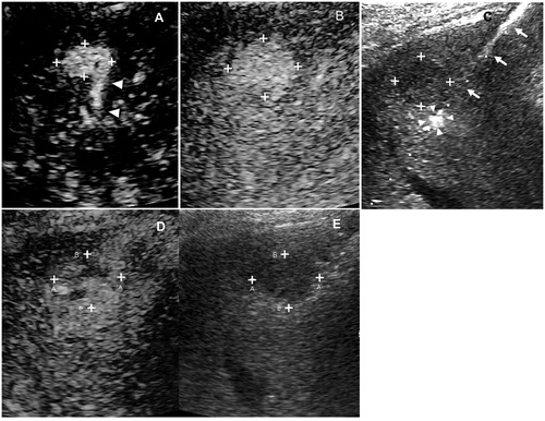 Figure 5. Images in a 43-year-old male with recurrent HCC measured 2.8 cm in diameter. (A) one feeding artery (arrowhead) of the tumor (cross) was depicted in the early arterial phase of 2D-CEUS. (B) Before FAA, 2D-CEUS showed hyperenhancement of the entire tumor at 23 s. (C) FAA created a small ablation zone (arrowhead) using 2 cycles and 8 min cauterization mode. The target tumor was intact (cross). The arrow showed the electrode inserting path. (D,E) After FAA, dual imaging showed intratumoral enhancement defect of the tumor at 23 s, which identified as a partial perfusion response to FAA. FAA: feeding artery ablation; CEUS: contrast-enhanced ultrasound.