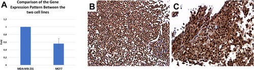 Figure 4 YAP1 expression in MCF-7 and MDA-MB-231 breast cancer cell line. (A) qRT-PCR analysis showing no significant difference in YAP1 expression between MCF-7 and MDA-MB-231 breast cancer cell lines. (B, C) Immunohistochemical expression of YAP1 in cytoplasm and nucleus in both MCF-7 (B) and MDA-MB-231 (C) cells (Immunoperoxidase, x200).