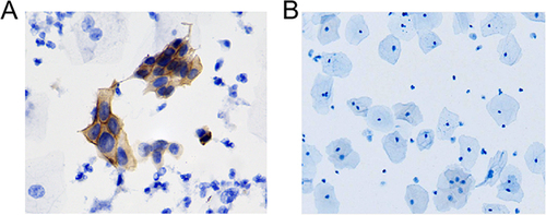 Figure 1 Immunocytochemical staining of E7 in exfoliated cervical cells (E7-ICC staining). (A) In an E7-positive result, the cytoplasm was stained brown; (B) In an E7-negative result, the nucleus and cytoplasm were bluish-purple without brown. E7-ICC staining ×20.