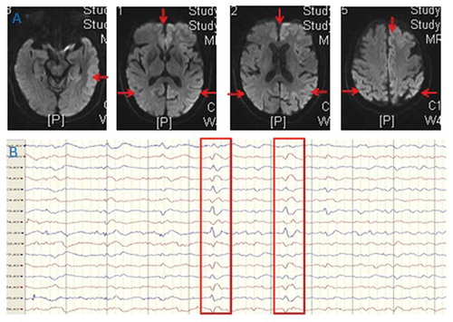 Figure 1. MRI (A) findings of bilateral cortical diffusion restriction presenting with hyperintensive signal in the cortex on diffusion weighted imaging. EEG (B) showed slowing and periodic discharges over bilateral hemisphere with triphasic morphology.
