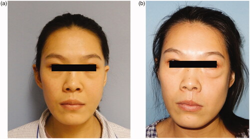 Figure 6. (a) Pre-operative facial profile. (b) Post-operative facial profile.