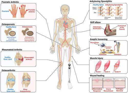 Figure 1 The functions of Metrnl in inflammatory-mediated pathological bone osteolytic diseases. Created with BioRender.com. Metrnl is correlated with some metabolic and inflammatory orthopedic diseases. Studies indicated it play crucial roles in inflammatory reactions, bone metabolism, osteogenesis, muscle regeneration and angiogenesis, and have deep relationship with the development of multiple orthopedic diseases, like psoriatic arthritis, osteoporosis, rheumatoid arthritis, osteoarthritis, axial spondyloarthritis, aseptic loosening, elbow stiffness, muscle injury and wound healing.