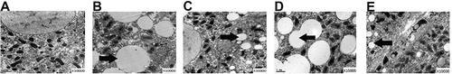 Figure 4 Ultrastructural changes in the liver of diabetic rats before and after L6H4 treatment under scanning microscope (A–E) among various groups. Lipid particles fused into huge fat drops in the HF and DM groups (Black arrow in B and D), which was decreased in rats treated with L6H4 (C and E).