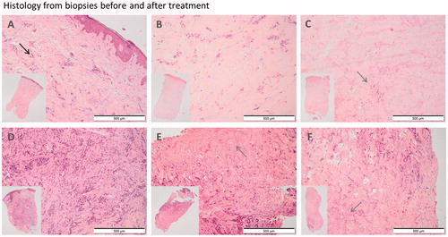 Figure 3. Punch biopsies before and one week after treatment. A–C: Patient no. 3, with nine metastases from breast cancer on the right nates. A: Pre-treatment biopsy: Skin biopsy with a moderate amount of tumor infiltration (black arrow) and fibrosis within the dermis. There is mild inflammation and no necrosis. B: Day 7. Post-treatment with calcium electroporation: Ulcerated skin biopsy with the same amount of tumor infiltration as in the pretreatment biopsy and moderate fibrosis. There is no inflammation or necrosis. C: Day 7. Post-treatment with electrochemotherapy: Ulcerated skin biopsy with no evidence of tumor but a large amount of necrosis (grey arrow) and fibrosis and with mild inflammation. D–F: Patient no. 5 with ten metastases from breast cancer on her left breast and abdomen. D: Pre-treatment biopsy: Skin biopsy with extensive tumor infiltration, moderate fibrosis and minimal inflammation. No evidence of necrosis. E: Day 7. Post-treatment with calcium electroporation: Skin biopsy with less tumor infiltration than in the pretreatment biopsy and a moderate amount of necrosis and fibrosis. There is minimal inflammation. F: Day 7. Post-treatment with electrochemotherapy: Skin biopsy with moderate tumor infiltration, necrosis and fibrosis. There is minimal inflammation.