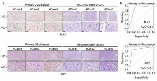 Figure 9. LIM homeobox 5 (LHX5) and T cell leukemia homeobox 1 (TLX1) were downregulated in the recurrent GBM tissues and exhibited high diagnostic value. (a) Immunohistochemical (IHC) staining was used to determine the expression of LHX5 and TLX1 in the recurrent GBM tissues and primary GBM tissues. (b) Receiver operating characteristic (ROC) analysis was performed to determine the diagnostic value of LHX5 and TLX1 in distinguishing between the recurrent and primary GBM tissues