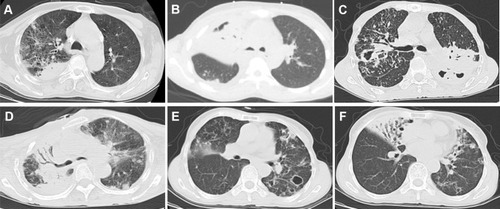 Figure 2 Chest computed tomography (CT) showing exudation and consolidation in the upper lobe of the right lung (A from patient 3); atelectasis in the middle lobe of the right lung and right pleural effusion (B from patient 7); consolidation in the lower lobe dorsal segment of the left lung with cavity formation and thick-walled cavities, nodules, patches, and fiber proliferation in the upper lobe of the right lung (C from patient 8); right thoracic collapse, large consolidation in the upper lobe of the right lung with air bronchogram signs, and multiple ground-glass opacities, patchy exudations and nodules in the upper lobe of the left lung (D from patient 1). Multiple patchy exudations, bronchiectasis and multiple thin-walled cavities of varied sizes in the lower lobe of the bilateral lung (E from patient 8). Multiple areas of bronchiectasis, consolidation and exudation in the middle lobe of the right and left lungs (F from patient 8).