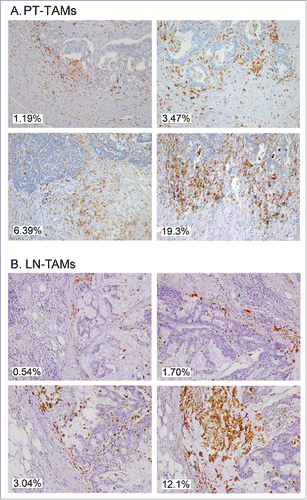 Figure 4. Immunostaining of CD68+ TAMs at the invasive margin of primary colorectal cancer (A) and of metastatic lymph-nodes (B). Examples of tissue areas with variable extent of CD68-immunoreative area (% IRA in white boxes).