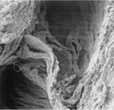 Figure 3 Pseudocyst lacking of endothelium, anfractuous, and lined by fragmented elastic fibers and smooth muscle cells with fibrous or fibrin bridges in its lumen, ×1,500.