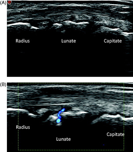 Figure 1. Dorsal longitudinal ultrasound scan of the wrist of a healthy person. Clearly seen is a positive power Doppler signal superficial to and entering the lunate bone. The Doppler signal is due to a feeding vessel; the signal can easily be mistaken for synovitis or erosion.