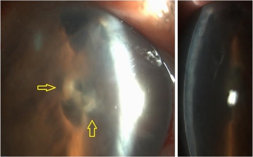 Figure 2 Slit-lamp images depicting the detached Descemet membrane and synechiae at the level of the pupil following descemetorhexis. Note the severe edema due to the absence of corneal endothelium (yellow arrows).