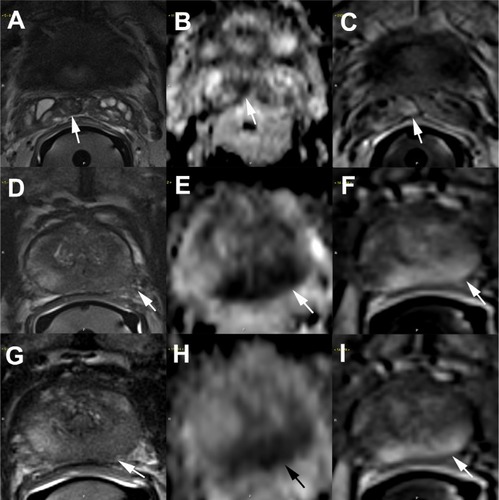 Figure 1 Example of extracapsular extension detected on multiparametric prostate MRI.