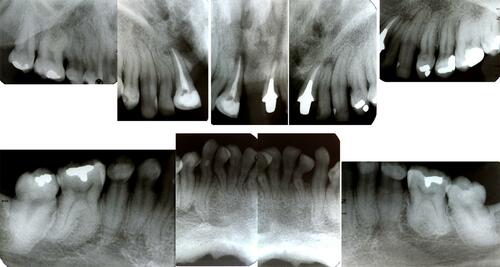 Figure 6 Full-mouth periapical X-ray.