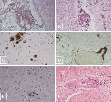 Figure 1 A) Association of lymphocytic angiitis and amyloid deposits infiltrating the wall of leptomeningeal vessel and perivascular cuffing of mononuclear cells (hematoxylin-eosin-safran original magnification X 10). B) Mononulear cells surrounding a non amyloid cortical vessel with severe intimal fibrosis occluding the lumen (hematoxylin-eosin-safran original magnification X 20). C) Amyloid deposits present in the senile plaques immunostained for bA4 (original magnification X 40). D) Amyloid deposits present in the wall of vessels in the neocortex immunostained for bA4 (original magnification X 40). E) Neurofibrillary tangles immunostained for tau protein (original magnification X 10). F) Giant cell arteritis in the myocardium (hematoxylin-eosin-safran original magnification X 40).