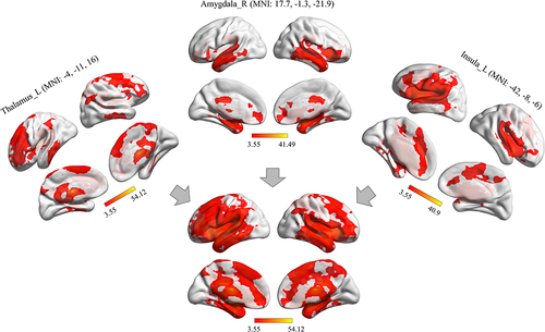 Figure 3 Coordinate-based network of the sleep-related mapping construct. Exacted coordinates that were previously reported to be significantly correlated with the sleep functional connectivity network in the left thalamus, right amygdala, and left insula. Three connectivity maps were created for each patient, and the result was performed by one sample t test (voxel-wise uncorrected p < 0.001, FWHM=6 mm, cluster size > 351 mm3, corrected p < 0.05, determined by Monte Carlo simulation). The conjunction of these corrected networks was mainly distributed in fronto-temporal-parietal cortical and subcortical regions (indicated by the grey arrow), comprising the salience network (SN), sensory-motor network (SMN), auditory network (AN) and default mode network (DMN) sleep-related key regions previously reported.