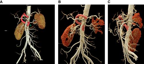 Figure 4 (A). 3D reconstruction of the laparoscopic retrograde aorto-splenic bypass, with graft kinking (green arrow). Hem-o-loc clips on the excised side graft (yellow arrow). (B and C). Anterior and left lateral view of the revised laparoscopic aorto-splenic bypass.
