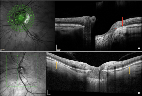 Figure 1 OCT features of gamma peripapillary atrophy and peripapillary staphyloma (PPS). (A) Gamma peripapillary atrophy is the area free of Bruch’s membrane located between the red arrows, extending from the optic nerve edge to the end of Bruch’s membrane. (B) PPS is characterized by a posterior bowing of the sclera around the optic nerve head with a local curvature steeper than that of the adjacent region, with the choroid showing thinning at the edge of the PPS (yellow arrows), followed by a rethickening towards the optic nerve head.