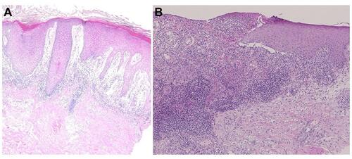Figure 5 (A) Histopathology of bullous lichen planus, showing bullous lesions below the elongated epidermis. (B) Histopathology of ulcerative lichen planus, showing the absence of the epidermis.