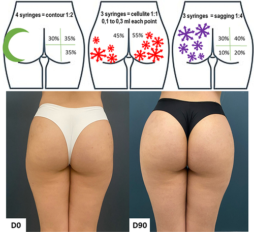 Figure 5 Case 3, Buttocks Beautification 3D. Schematic representation of the injections (above). Standardized posterior images pre and 90 days post injection (below). Each syringe = 1.5 mL of CaHA.