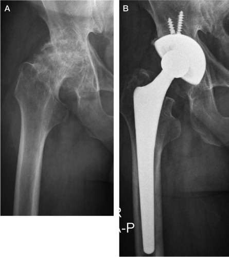 Figure 2.  The right hip of a 52-year-old man who was treated with hemodialysis for 12 years. A. Preoperatively, advanced osteoarthritis with a Dorr type B femoral canal. B. 11 years postoperatively, with a well-fixed prosthesis (Perfecta hip system; Wright Medical Technology).