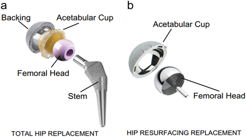 Figure 1. Components used in hip implants (Bhawe et al., Citation2022).