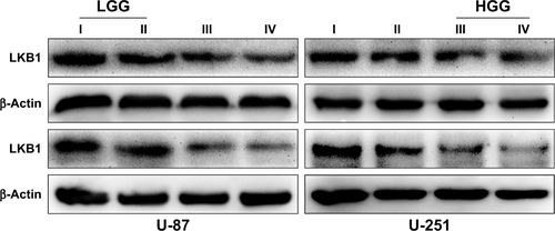 Figure S4 LKB1 level in low grade and high grade glioma.Abbreviations: HGG, high grade glioma; LGG, low grade glioma; LKB1, liver kinase B1.