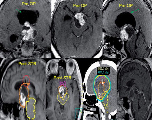 Figure 1. The top panel of images illustrates the pre-operative tumor morphology consisting of a mixed solid/cystic craniopharyngioma. The green arrow points to the large cyst responsible for the obstructive hydrocephalus resulting in this patient’s acute presentation of decreased level of consciousness. The patient underwent an emergency subtotal resection with cyst resection for decompression and the patient’s neurologic status returned to baseline. The post-operative magnetic resonance images (MRI) are shown on the bottom panel and labeled post-STR. The patient was then radiated adjuvantly with 54 Gy in 30 fractions. Typically the gross residual tumor is treated with a margin to encompass the post-operative bed. Representative isodose lines are provided on the planning CT-scan (3rd image from the left of the bottom panel). The follow-up MRI four years later indicates tumor stability (right-most image bottom panel).