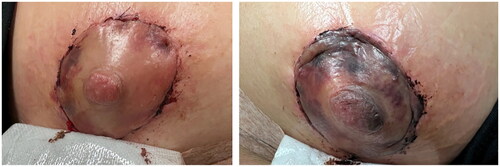 Figure 2. Photograph depicting significant discoloration of left NAC compared to right.