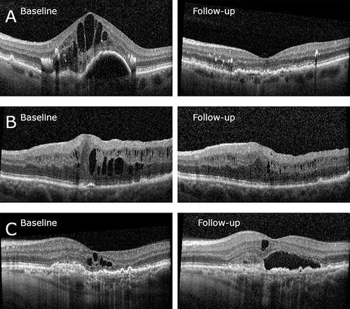 Figure 1 Examples of morphological response, showing OCT scan at baseline (left column) and corresponding B-scan at follow-up (right column). (A) Good response. At baseline presence of intraretinal fluid and a serous pigment epithelium detachment. At follow-up complete regression of intraretinal fluid. (B) Partial response. At baseline presence of intraretinal fluid. At follow-up decreased central retinal thickness of 35% with persistence of intraretinal fluid. (C) Nonresponse. At baseline presence of intraretinal fluid. At follow-up increase of central retinal thickness, persistence of intraretinal fluid and occurrence of subretinal fluid.