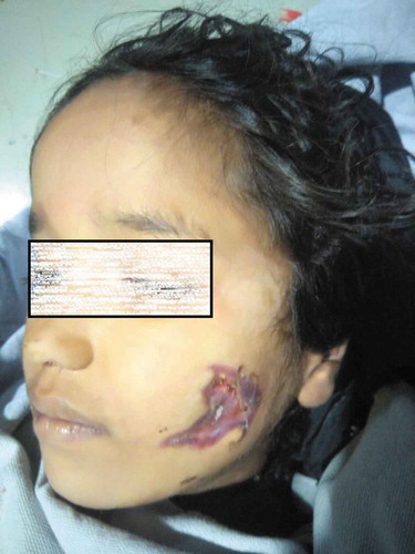 Figure 1. An eight-year-old girl with a deep lacerated facial wound over the left parotid region involving facial nerve.