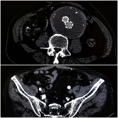 Figure 4 Follow-up CTA showing: (A) patent graft with exclusion of the aneurysm from circulation and without endoleak, Magnification X1. (B) Retrograde flow into RIIA, Magnification X1.