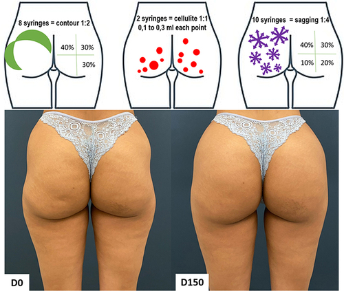 Figure 3 Case 2, Buttocks Beautification 3D. Schematic representation of the injections (above). Standardized posterior images pre and 150 days post injection (below). Each syringe = 1.5 mL of CaHA.