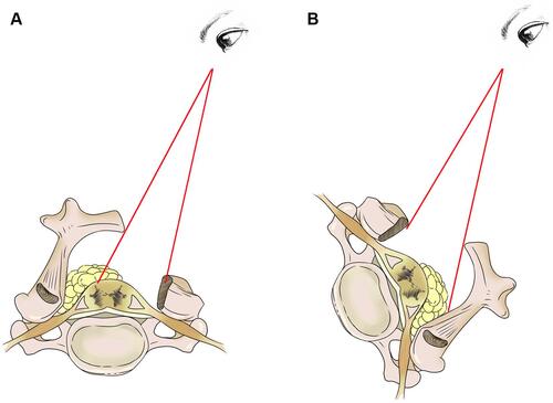 Figure 2 The lateral position facilitates intraspinal inspection. As the intraspinal view field was greater in the lateral position, it is possible to detach the adhesion under direct vision. (A) Prone position. (B) Lateral decubitus position.