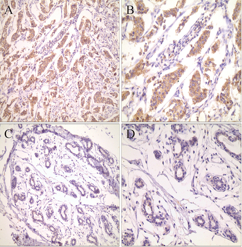 Figure 3 TIGIT expression in tumor tissues based on IHC (A, 200× and B, 400×) versus adjacent tissues (C, 200× and D, 400×).