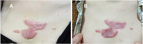 Figure 5 Example of keloid treated with intralesional 5-FU and betamethasone. (A) Before treatment, (B) at 6 months of follow-up.