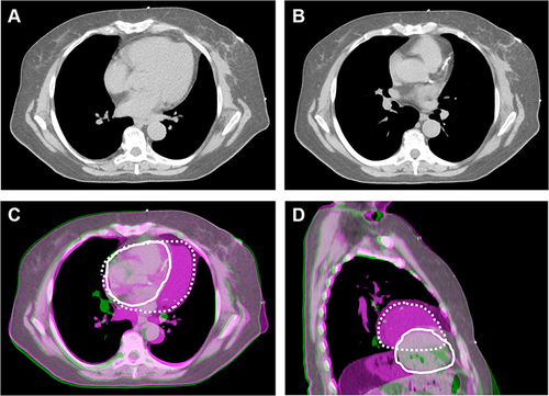 Figure 1 Cardiac position and proximity to the left breast target volume for a patient simulated in both free-breathing and DIBH positions. Position of the heart in free-breathing (A), demonstrating the proximity of the heart to the left breast and nodal target volume. Position of the heart in DIBH (B), demonstrating that the heart is positioned further away from the target volume. When the free-breathing (purple) and DIBH (green) images are fused based on the left breast target volume, the significant difference in cardiac position in the axial (C) and sagittal (D) planes can be appreciated. The position of the heart is contoured in white (solid white, DIBH; dashed white, FB). With DIBH, the heart is displaced inferiorly and medially, further away from the left lateral chest wall.