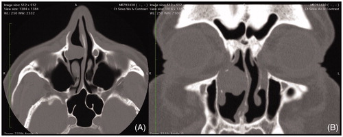 Figure 1. (A) Axial and (B) coronal computed tomography imaging of homogenous right nasal mass abutting lacrimal apparatus and causing mass effect with septal deviation.