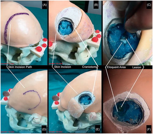 Figure 10. Qualitative comparison between AR and traditional surgical approaches to accessing the artificial lesions. Qualitative comparison between the two approaches to accessing the lesion: augmented reality-based approach (bottom row) vs standard approach (top row). A vs D: by using the augmented reality guidance the size of the skin incision results significantly smaller since the surgeon does not need to expose a large part of the skull vault to targeting the lesion. B vs E: the same concept supports the fact that the osteotomy results wider with the standard approach since the surgeon needs to expose parenchyma sulci and gyri as reference landmarks to navigate towards the lesion. C vs F: the target lesion was reached with both the approaches. However, with the standard approach (C) the eloquent area was considerably exposed (thus implying its possible damaging) and the lesion was not targeted at the center, whereas with the augmented reality approach (F) the lesion was centered and the eloquent area was only slightly exposed.