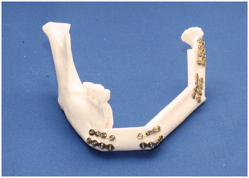 Figure 4. Experimental reconstruction of the mandibular RP model with fibula segments. The segments were cut with the manual method or with the STL fibula cutting guide. The metal miniplates are fixed to each joint.