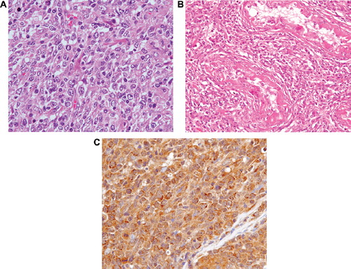 Figure 2. (A) Biopsy of the right testis showing diffuse proliferation of large lymphoid cells observed on histologic examination (hematoxylin-eosin stain (H&E); objective magnification × 40). (B) Biopsy of the right testis showing infiltration of lymphoma cells into the remaining seminiferous tubules (H&E, objective magnification × 20). (C) Abnormal cells positive for IFN-γ (objective magnification × 40).