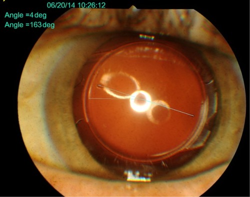 Figure 1 Postoperative digital analysis of Precizon® toric IOL rotation.