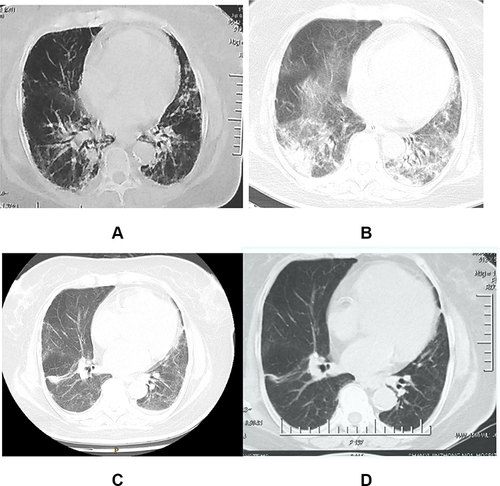 Figure 1 Chest CT before and after treatment (A) on July 4, 2019, early onset, out of hospital; (B) on July 12, 2019, when the condition became worse after admission; (C) on July 22, 2019, after treatment, the patient’s condition improved; (D) on August 12, 2019, re examination was conducted after discharge.