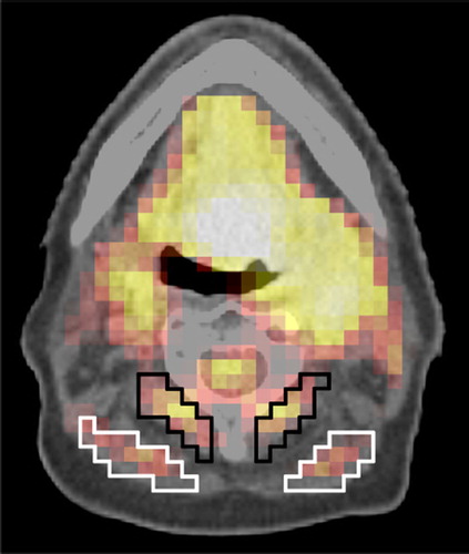 Figure 3. Examples of possible different background ROI definitions in neck muscles. The mean activities are 6.26 kBq/ml (SD 0.71) and 6.88 kBq/ml (SD 0.62) in the white and black region, respectively. The volumes of the black and white ROI are 3.3 cm3 and 3.9 cm3, respectively.