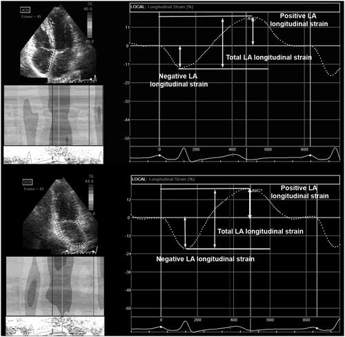 Figure 2. Two-dimensional left atrial (LA) strain analysis.