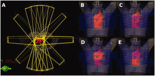 Figure 1. Beam setup for preplanning before optimization with 16 beam angles surrounding the patient (A) and examples of open and partially closed subfields that were created for each beam angle (B–E). The CTV is shown in red.